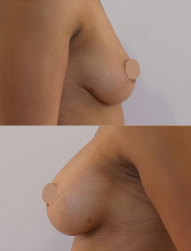Breast Lifting