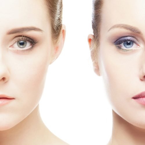 Botox2-min