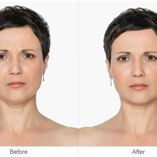 Botox3-min