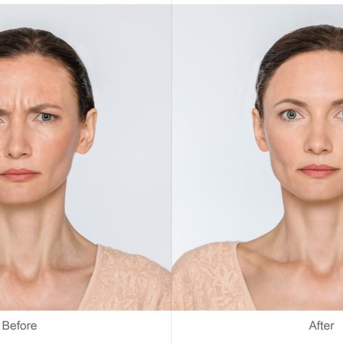 Botox4-min