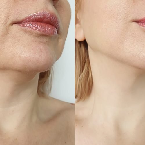 facefiller 4-min