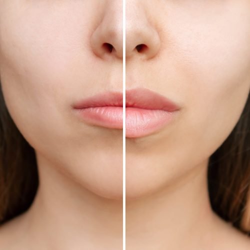 facefiller2-min