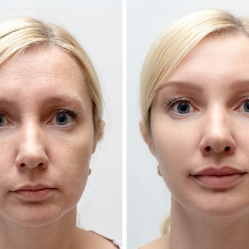facefiller3-min